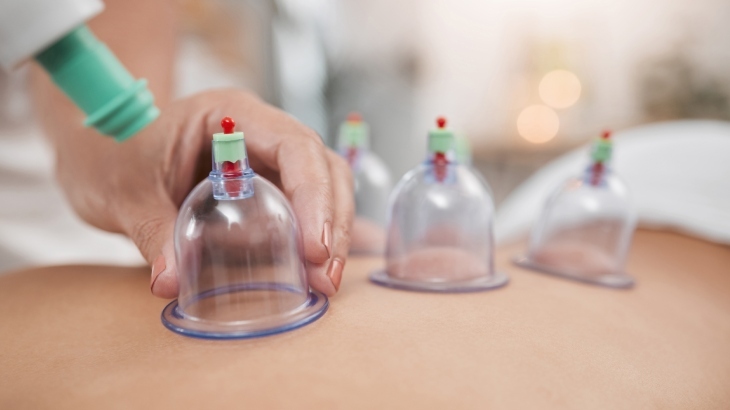 What is the reason for performing cupping at certain times?