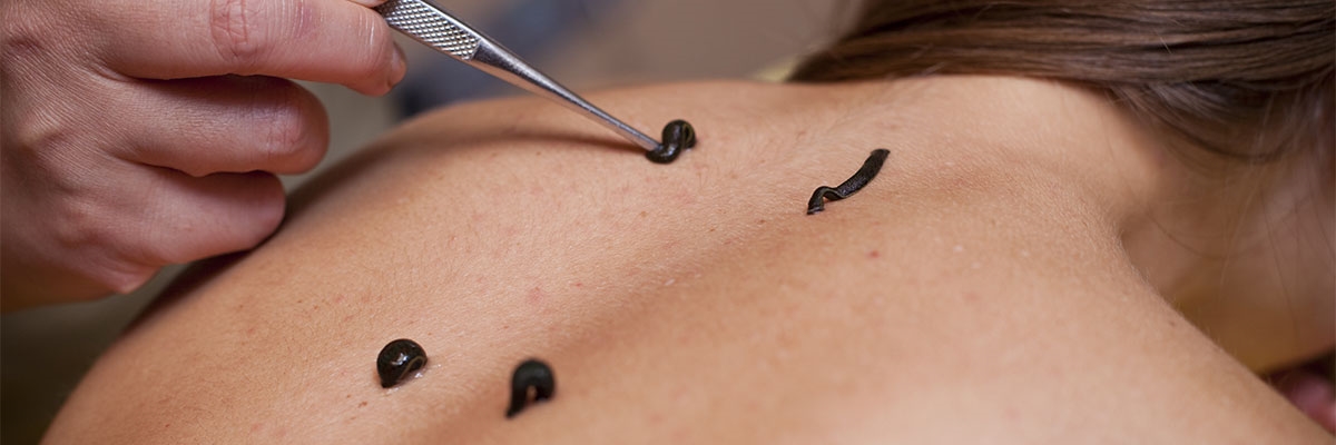 What is Leech Therapy?